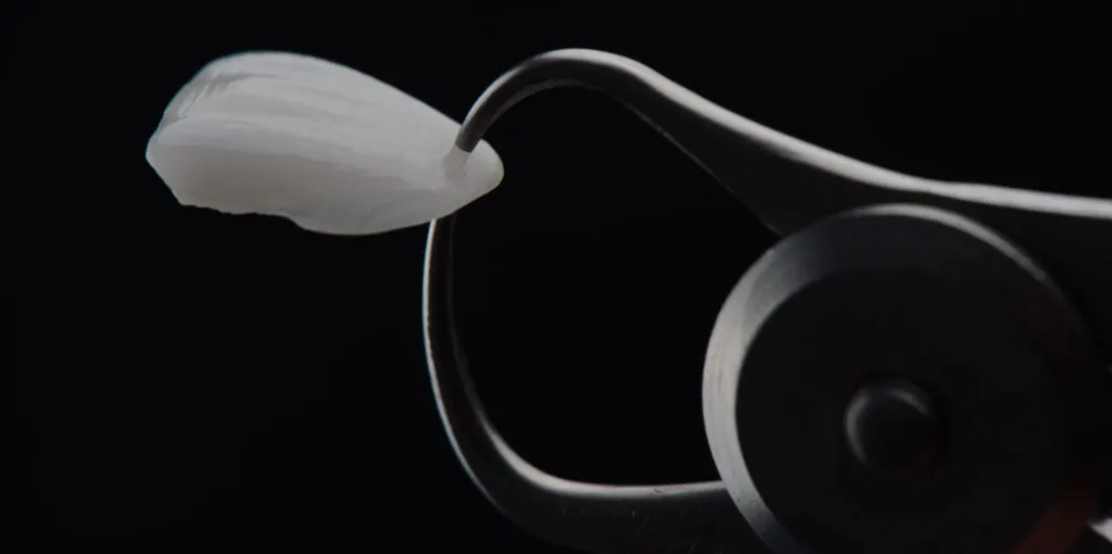 Extremely thin prepless dental veneer.