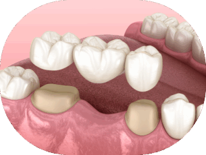 Close up of a dental bridge