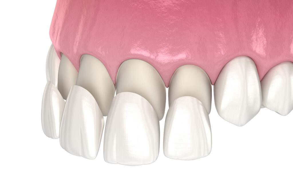 Porcelain dental veneers