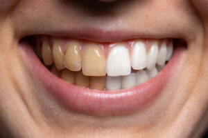 Before and after undergoing teeth whitening treatment.