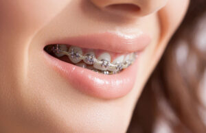 Traditional wire braces