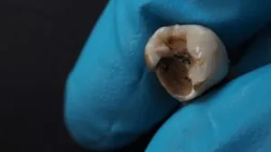 Severely decayed tooth