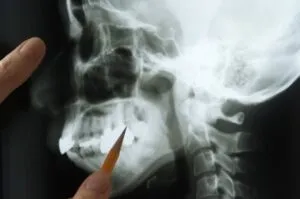 An image of a jawbone being examined by a dentist.