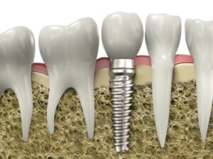 A graphic image of a dental implant placed in a jawbone.